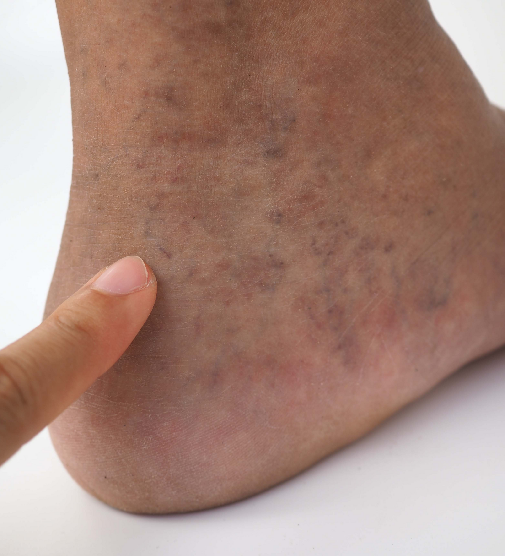 eczema varicoso della caviglia